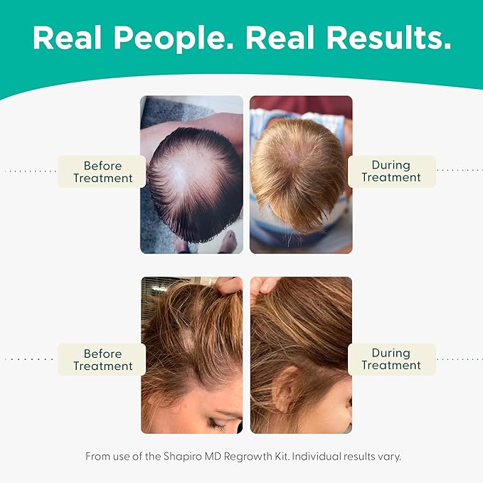 Shapiro MD Hair Growth Experts Hair Loss Shampoo and Conditioner, DHT Fighting Vegan Formula for Thinning Hair Developed by Dermatologists, Experience Healthier, Fuller Thicker Hair, 4 Month Supply