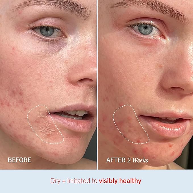 First Aid Beauty - Ultra Repair Cream, Intense Hydration Whipped Colloidal Oatmeal, Clinically Proven to Strengthen Skin Barrier & Help Relieve Eczema, Face & Body Moisturizer, 14oz Peppermint Twist