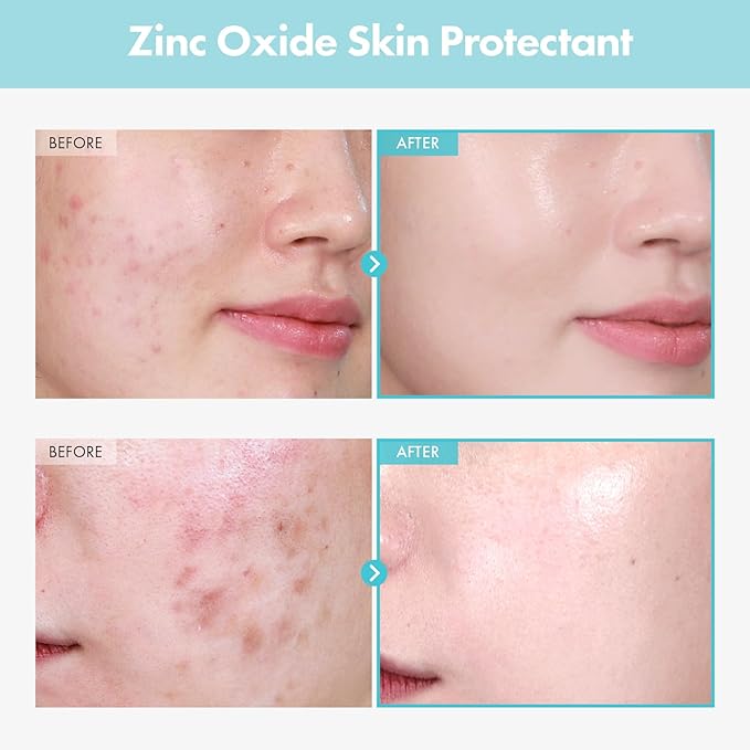 SOS Repair CICA Clinic Zinc Cream, 100,000ppm Zinc Oxide, Heal, Soothe Acne, Redness, Rosacea Treatment, Skin Barrier Repair, Moisture, Non-Comedogenic, Korean Skin care, 50g, 1.76 oz.