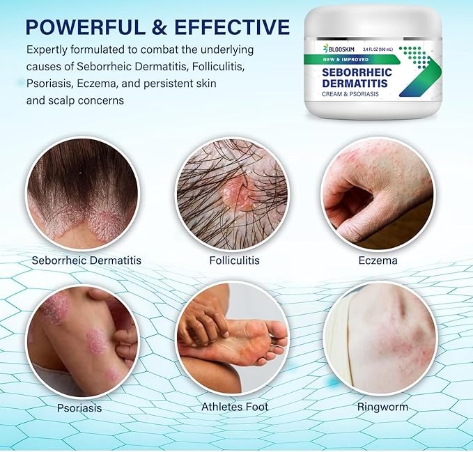 Seborrheic Dermatitis Face Cream – Face, Scalp & Body Moisturizing Treatment for Flaky, Itchy Skin – Daily Lotion for Psoriasis and Dermatitis Relief - Men and Women - 3.4 Fl Oz