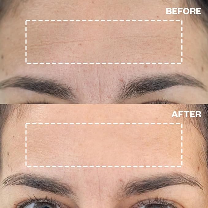 Wrinkles Schminkles Forehead Wrinkle Patches, 2-Pack, Reusable Hypoallergenic Silicone Smoothing Pads + Silicone Patch Cleanser 2 oz, Clean Silicone Patches Without Breaking Down The Adhesive