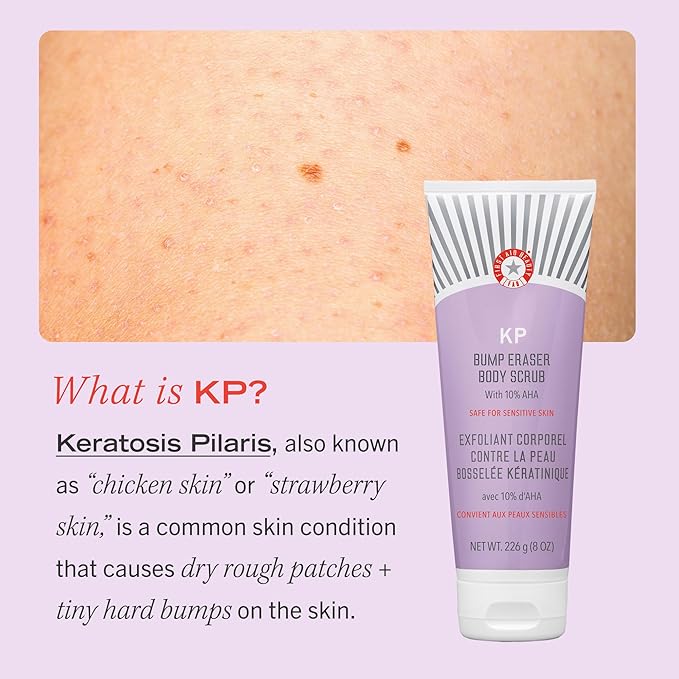 First Aid Beauty KP Bump Eraser Body Scrub Exfoliant for Keratosis Pilaris with 10% AHA 2 oz.