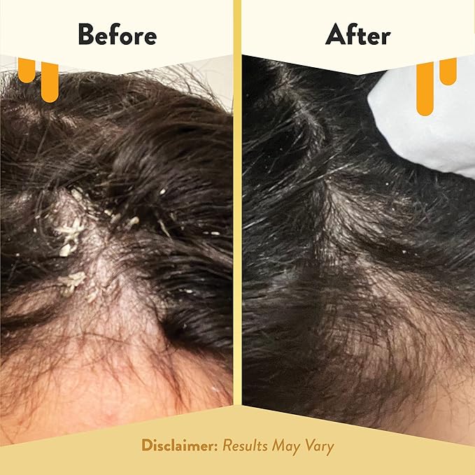 ECZEMA HONEY Soothing Scalp Oil - Natural Honey Hair Oil & Scalp Care - Daily Itchy Scalp Relief Serum - Dry Scalp Treatment Helps With Psoriasis, Seborrheic Dermatitis, Dandruff & More (1 Oz)