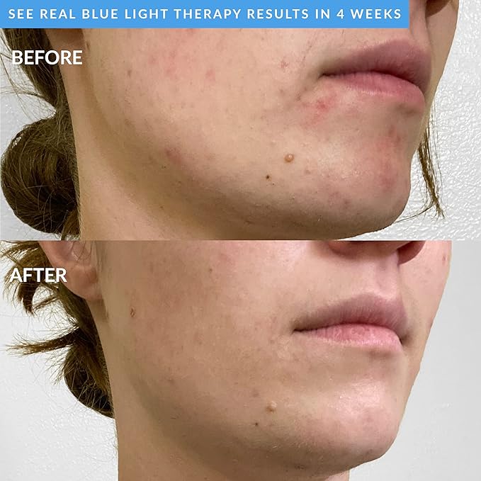 PMD Beauty Facial Cleansing Brush - Smart Silicone Brush with Blue Light Treatment - SonicGlow Vibration - Waterproof Device for Acne