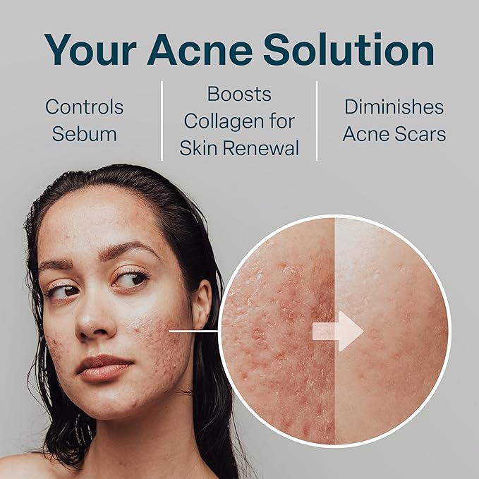 QRxLabs Salicylic & Glycolic Acid Acne Control Pads - 50 Count Jar - Glycolic & Salicylic - Bacne Treatment with Vitamins B5, C & E, Calendula & Green Tea