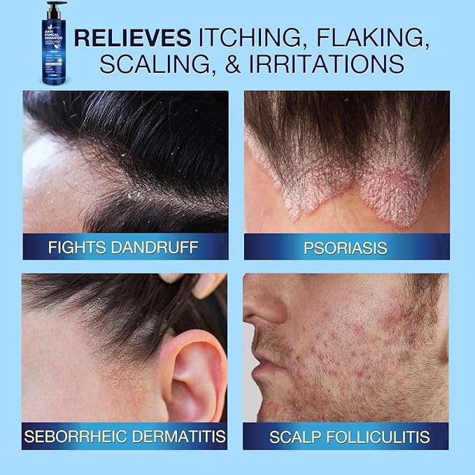 Anti-Fungal Shampoo for Scalp Psoriasis: Dandruff Shampoo for Folliculitis and Seborrheic Dermatitis - Relieves Itchy & Dry Scalp - 300 mL / 10.1 fl.oz