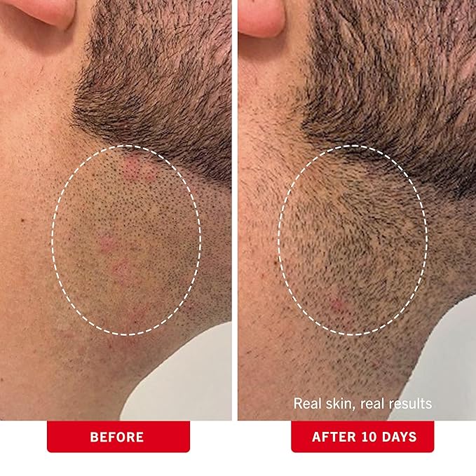 First Aid Beauty - Ingrown Hair Pads with BHA + AHA - Aftershave Treatment Pads Help Men & Women Prevent Razor Bumps, Exfoliate Underarms & Bikini Area, Compostable for Daily Use - 3ct, 84 Pads Total