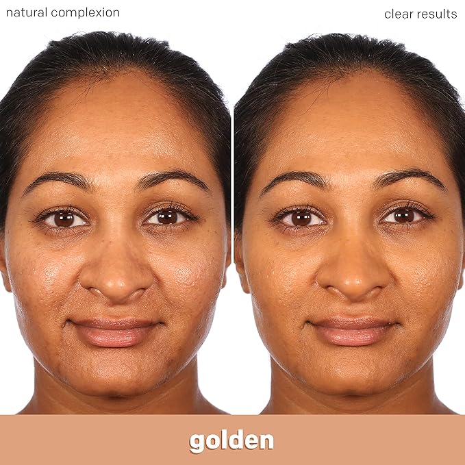 Almay Clear Complexion Acne Foundation Makeup with Salicylic Acid - Lightweight, Medium Coverage, Hypoallergenic, Fragrance-Free, for Sensitive Skin, 705 Toast, 1 fl oz.